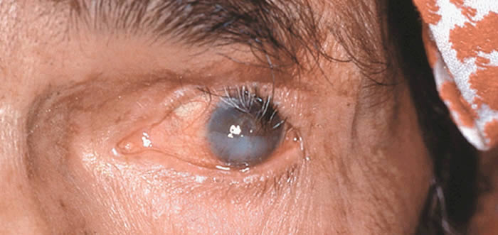 Abnormal Eyelashes Trichiasis